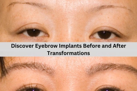 eyebrow implants before and after